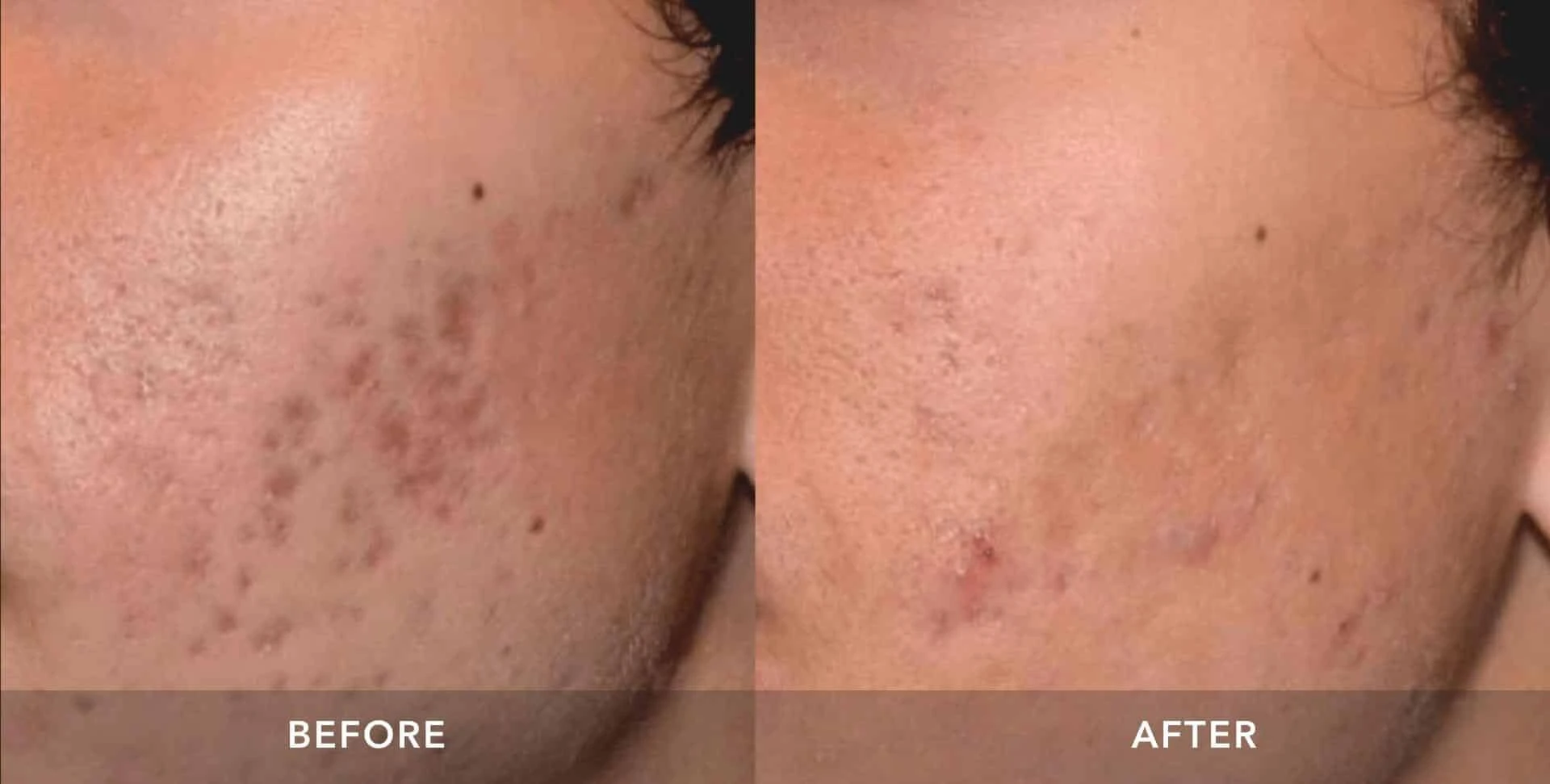 1004da8ff770b74047965a092da612b2 Pico Laser Before and After: Transforming Your Skin