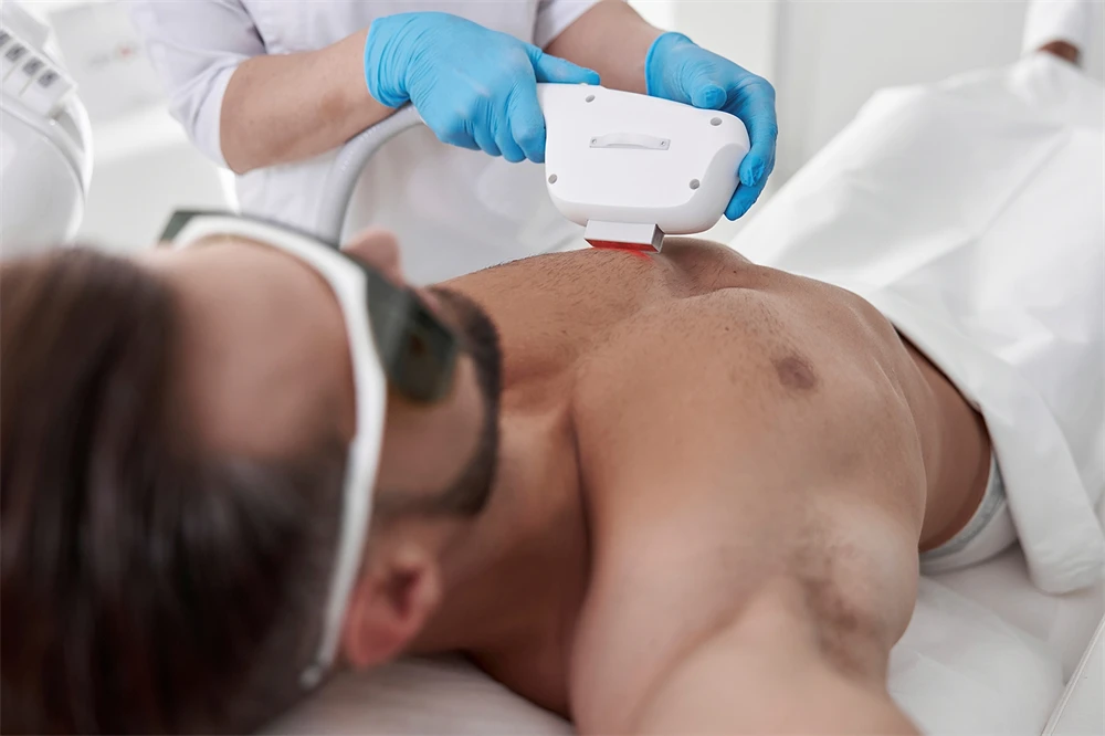 Laser hair removal on male chest