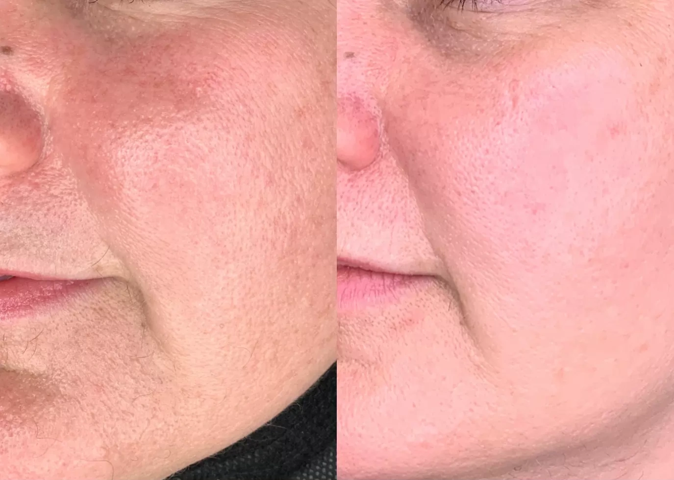 64b743f81b2ce361b9fd0bcf90475248 Pico Laser Before and After: Transforming Your Skin