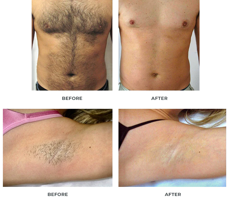 de57f8c93a66bd985b53dd403d3b537c 808 Diode Laser vs IPL: Unveiling the Best Hair Removal Solution